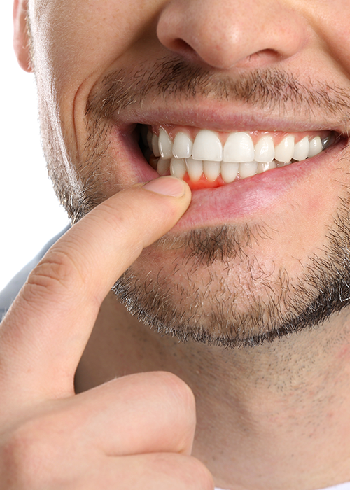 A man pulling down his lip to show irritated gums.
